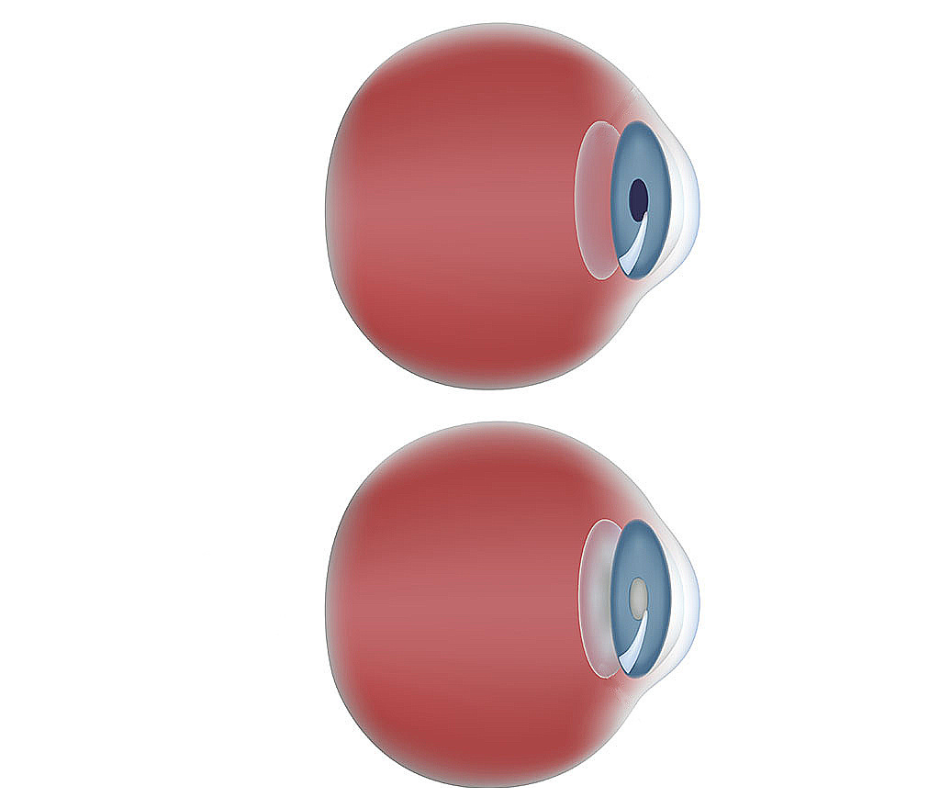 Cataract
