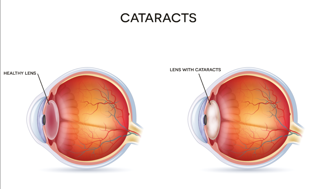 Cataracte